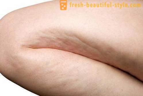 From what cellulite? The causes of cellulite formation. Methods of combating, prevention