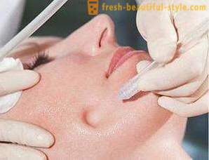 The gas-liquid peeling face: description of the procedure, features and reviews