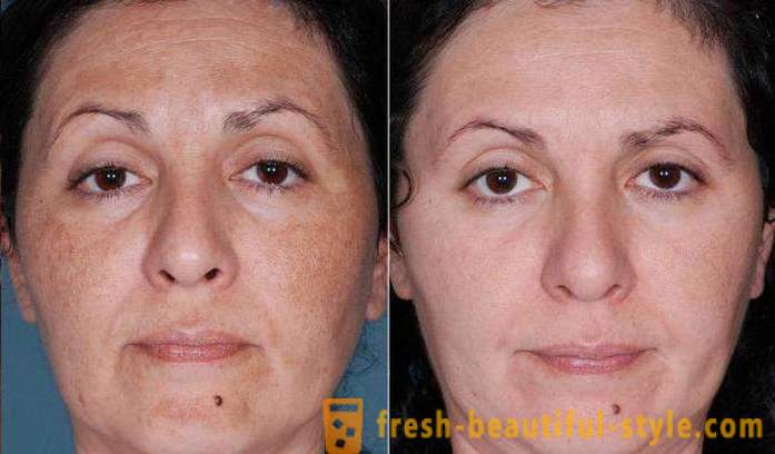 Acid peels for the face: reviews, photos before and after