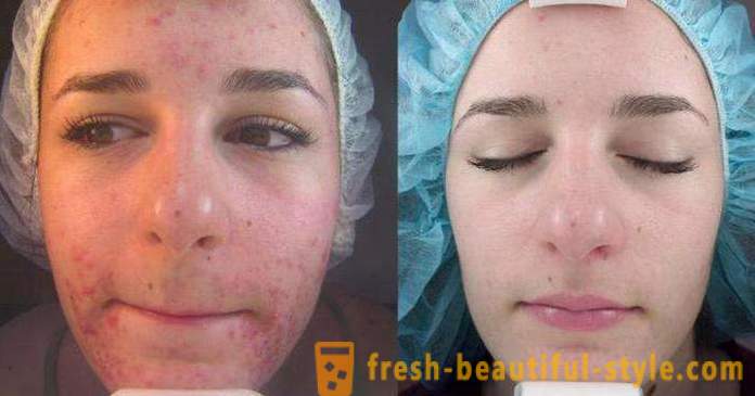Acid peels for the face: reviews, photos before and after