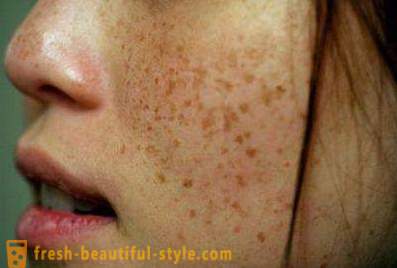 Brown spots on the face: the causes of and treatments. Dark spots