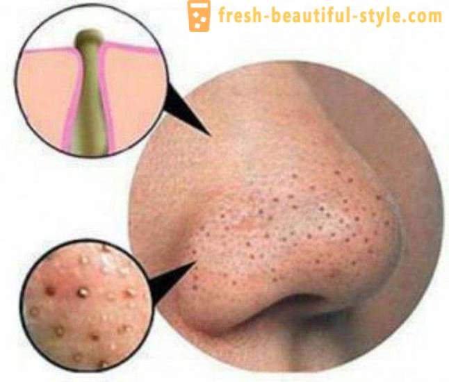 Means of black dots on the face: a review of effective drugs, masks, creams. How to get rid of blackheads on the face