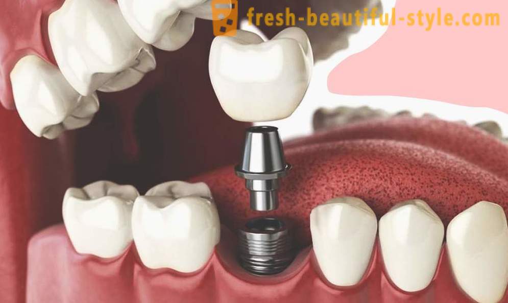 4 questions about dental implants