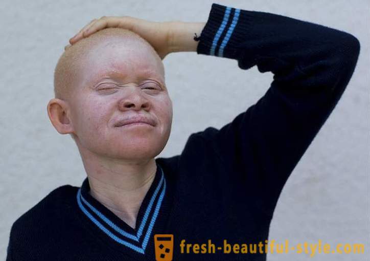 The tragic history of Tanzanian albinos