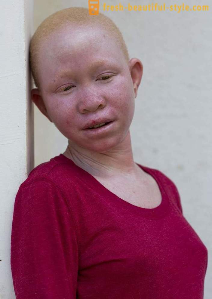 The tragic history of Tanzanian albinos