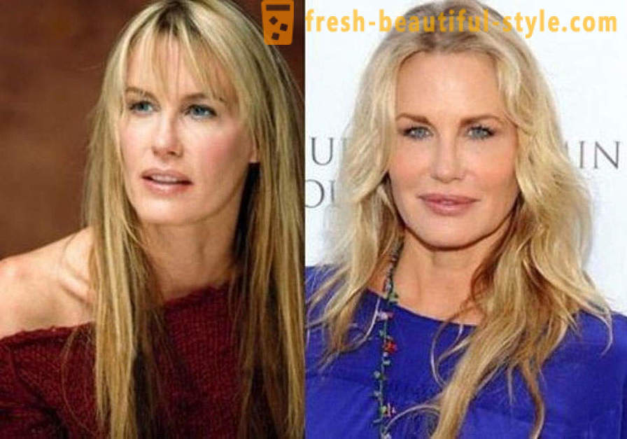 15 celebrities, finished badly with Botox