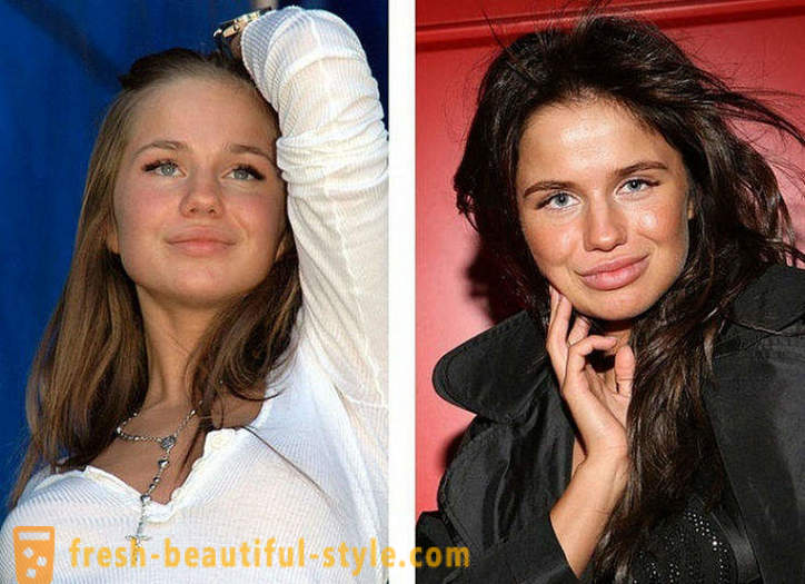 10 Russian beauties before and after plastic