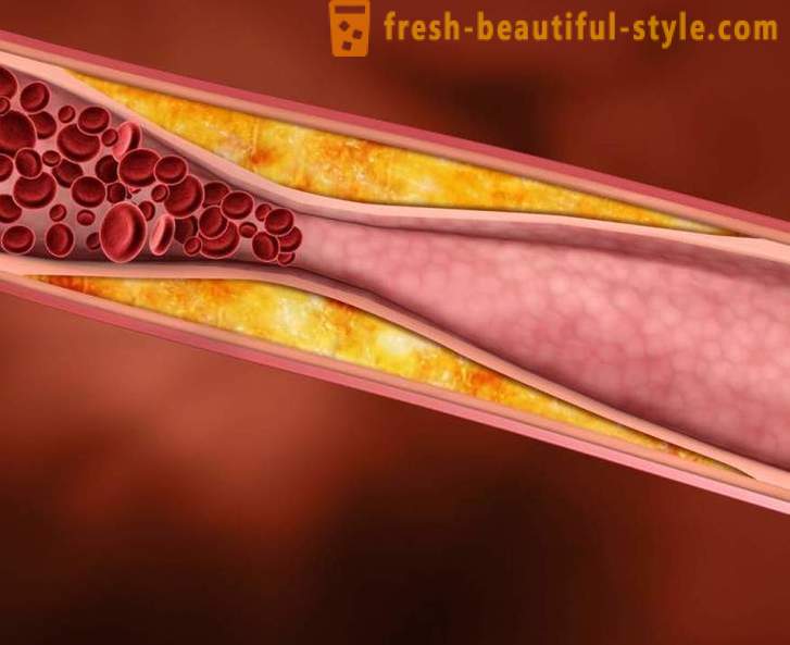 How to lower cholesterol without medication and clean the vessels
