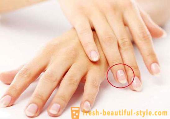White spots on the nails of the fingers: the causes of and treatment