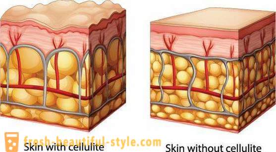 How to choose a cellulite cream: customer reviews and advice beauticians