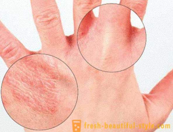 Dry skin of hands: Causes. Very dry skin, what to do?