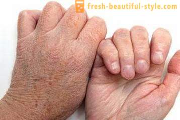 Dry skin of hands: Causes. Very dry skin, what to do?