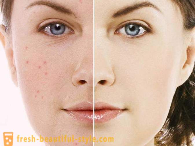 Badyaga stain of acne: reviews. Badyaga (gel) of age spots