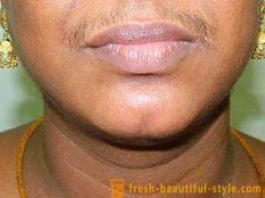 Facial hair in women: the causes of growth and removal