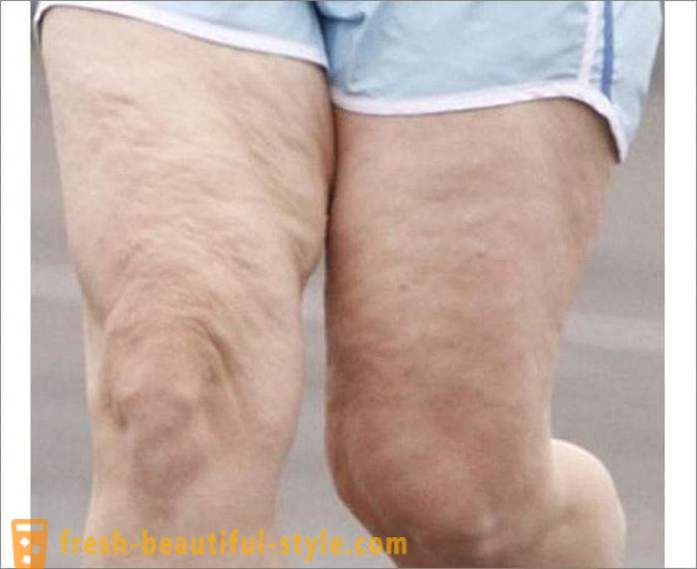 How to get rid of cellulite on legs? Exercises for the legs of cellulite