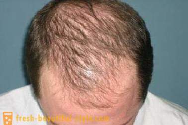 How to accelerate the growth of hair on the head? Restoration of hair growth