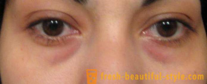Bags under the eyes: how to remove them?
