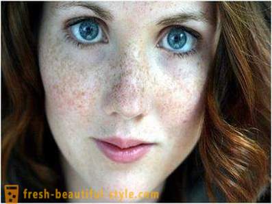 Take care of their beauty and youth: causes pigmentation on the face