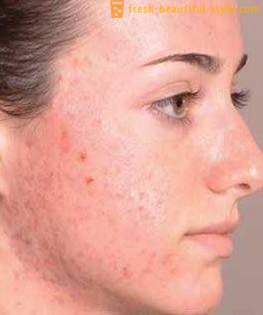 How to get rid of traces after acne and restore skin nice view?