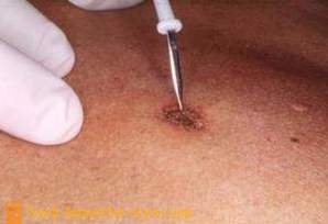 Removal of papillomas in the home folk remedies