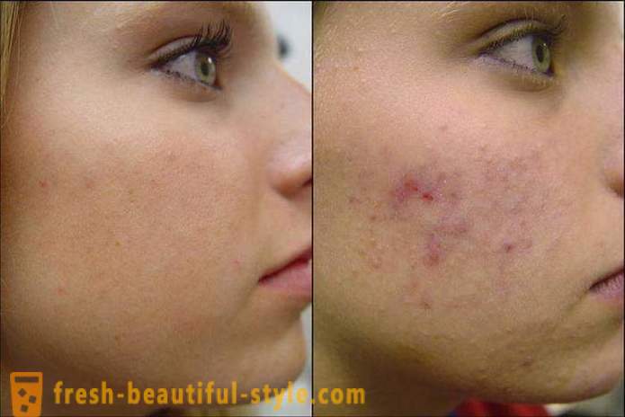 How to clean your face of acne so that they no longer returned